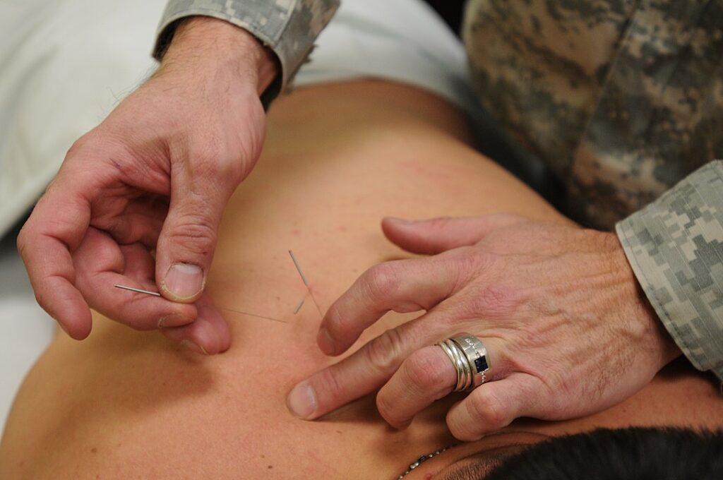 1084px Acupuncture u.s. military